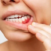 Gingivitis on Overall Health